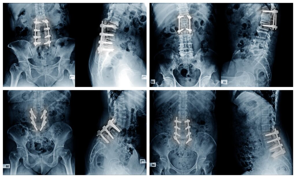 <strong>Lumbar Fusion: Everything You Need to Know</strong>